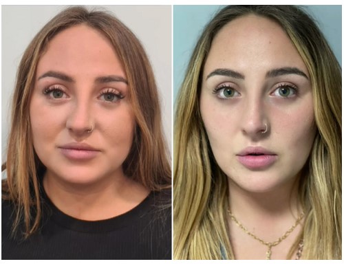 Bichectomía caso 1 — antes y después